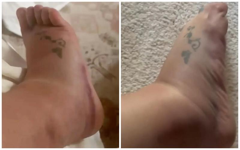 Бритни Спирс не хочет лечить сломанную ногу: тело сможет исцелиться самостоятельно