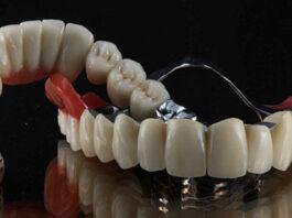 Бюгельні зубні протези: сучасне рішення для відновлення зубного ряду Бюгельні зубні протези