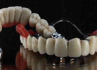 Бюгельні зубні протези: сучасне рішення для відновлення зубного ряду Бюгельні зубні протези